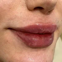 آموزش ژل و بوتاکس