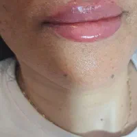 بوتاکس فیلر ژل