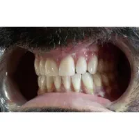 ساخت انواع دندان مصنوعی|خدمات آرایشگری و زیبایی|تهران, وحیدیه|دیوار