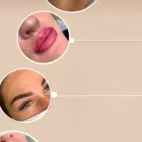 مدل فقط جهت فیبروز ابرو