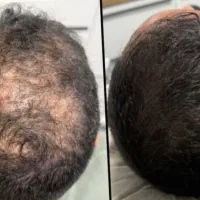 خداحافظی با ریزیش مو