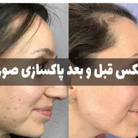 پاکسازی صورت