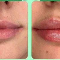 هایفو بوتاکس ژل لب زاویه سازی فیلر بادی هیپ سینه|خدمات آرایشگری و زیبایی|تهران, نارمک|دیوار