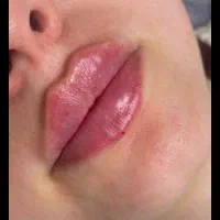 تزریق ژل و بوتاکس با مواد اصل و اورجینال|خدمات آرایشگری و زیبایی|ساری, |دیوار