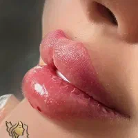 آفر ویژه تزریق فیلر و مزو|خدمات آرایشگری و زیبایی|تهران, تهرانپارس جنوبی|دیوار