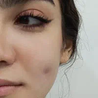 پیرسینگ .چال لپ،تاتوبدن، میکرو درمال
