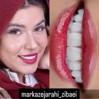 ایمپلنت کامپوزیت لمینت بلیچینگ عصب کشی ارتو