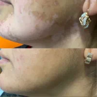 بهبود پیسی و پسوریازیس