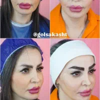 کاشت ابرو تخصصی در کیلینیک گلسا