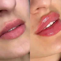 فیلرلب روسی ،گونه و زاویه،بوتاکس، فول فیس،زیرچشم|خدمات آرایشگری و زیبایی|شیراز, ستارخان|دیوار