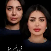 جشنواره پک مادلینگ +بوتاکس رایگان(فک لب گونه چانه)|خدمات آرایشگری و زیبایی|قم, زنبیل آباد|دیوار
