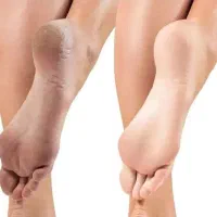 کرم ترک پا  ویتابلا
