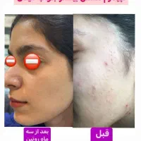رایگان نیست دادن روتین پوست فقط آنلاین|آرایشی، بهداشتی، درمانی|اصفهان, عاشق‌آباد|دیوار