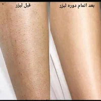 لـیزر موهای زائد/الکساندرایت/پی ار پی/پاککردن تاتو|خدمات آرایشگری و زیبایی|مشهد, آزادشهر|دیوار