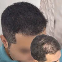 میکرواسکالپ / مکمل کاشت مو|خدمات آرایشگری و زیبایی|دوگنبدان, |دیوار