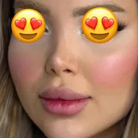 تزریق ژل بوتاکس پی ارپی درکلینیک توسط پزشک