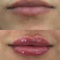 خدمات تزریق ژل و بوتاکس|خدمات آرایشگری و زیبایی|مشهد, عسگریه|دیوار