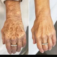 بیوممتیک اورجینال(سفیدی تضمینی)