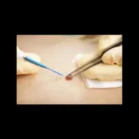 زگیل تناسلی