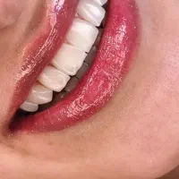 کلنیک دندان پزشکی/لمینت/ کامپوزیت