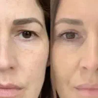 جشنواره پاییزی تخفیف ۵۰٪ بلفاروپلاستی تا اخر هفته|خدمات آرایشگری و زیبایی|تهران, قیطریه|دیوار