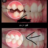 کامپوزیت فیسینگ ارتودنسی بزرگسالان و کودکان بیهوشی|خدمات آرایشگری و زیبایی|شیراز, زرگری|دیوار
