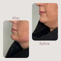 لیپوغبغب در جشنواره ۱۶ملیون