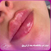 جشنوار تابستانه ژل و بوتاکس و شرایط اقساطی|خدمات آرایشگری و زیبایی|آمل, |دیوار