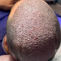 فیلرلب،کاشت مو،ابرو،پی ارپی،مزو