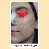 اگه دنبال پوست خوبی پیام بده|آرایشی، بهداشتی، درمانی|خلخال, |دیوار