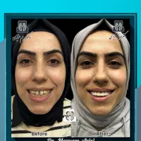 پایتخت لمینت کامپوزیت دندان ، خدمات دندانپزشکی|خدمات آرایشگری و زیبایی|شیراز, معالی‌آباد|دیوار