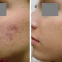 ریمو تتو ابرو،بدن کربن تراپی بادستگاه پیشرفته‌|خدمات آرایشگری و زیبایی|اهواز, کیانپارس |دیوار