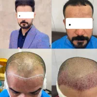 کاشت مو هیرسا با تیم پزشکی VIP|خدمات زیبایی و سلامت|تهران, سهروردی|دیوار