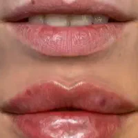 مزونیدلینگ مزوتراپی خالبرداری لیزر|خدمات زیبایی و سلامت|تهران, میرداماد|دیوار