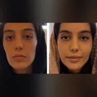 تزریقات ژل شروع قیمت از 750|خدمات آرایشگری و زیبایی|شیراز, شهرک مفتح|دیوار