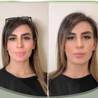 تزریق مزو ژل و آب رسانی پوست