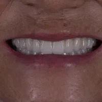 دندانسازی (دندان مصنوعی)|خدمات آرایشگری و زیبایی|اصفهان, وحید|دیوار