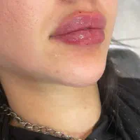 کلینیک تخصصی زیبایی/ ژل / بوتاکس / مزوتراپی / prp