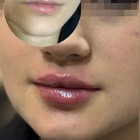 تزریق ژل و بوتاکس