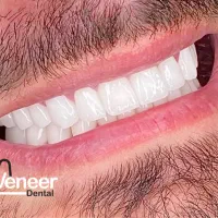 دندانپزشکی ایمپلنت کامپوزیت لمینت ( اقساط بدون سود|خدمات آرایشگری و زیبایی|تهران, الهیه|دیوار