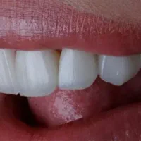 جشنواره بزرگ یلدادستدندانطبیعی+ایمپلنت+کامپوزیت|خدمات آرایشگری و زیبایی|تهران, فلسطین (میدان انقلاب)|دیوار