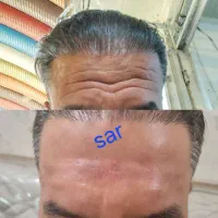 تزریق وآموزش ژل وبوتاکس  ۲۵۰۰ درکلینیک|خدمات آرایشگری و زیبایی|اهواز, بیست متری شهدا|دیوار