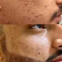 کاشت مو / ابرو / مژه|خدمات آرایشگری و زیبایی|تهران, زعفرانیه|دیوار