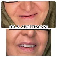 لمینت لیرینگ  ده تومن پیش پرداخت اصفهان|خدمات آرایشگری و زیبایی|شهرضا, |دیوار