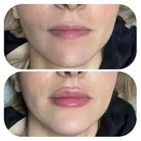 تزریق ژل و بوتاکس|خدمات آرایشگری و زیبایی|امیدیه, |دیوار