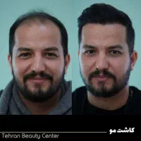 کاشت ابرو/ریش/مو/بوکال فت/بلفاروبلاستی