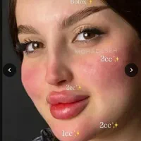 ژل،بوتاکس،فیلربادی باسن بیکینی،پی ارپی زاویه سازی|خدمات زیبایی و سلامت|تبریز, |دیوار