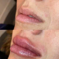 تزریق فیلر و بوتاکس با ماندگاری و نتیجه طبیعی|خدمات آرایشگری و زیبایی|تهران, مهرآباد|دیوار