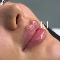 لیزر زیبایی