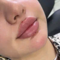 ژل و بوتاکس و خال برداری